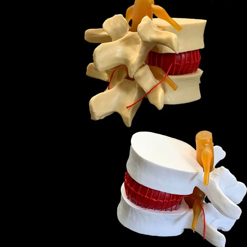 Examination Bed Medical - Anatomisches Demonstrationsmodell für menschliche Lendenwirbel, degenerative